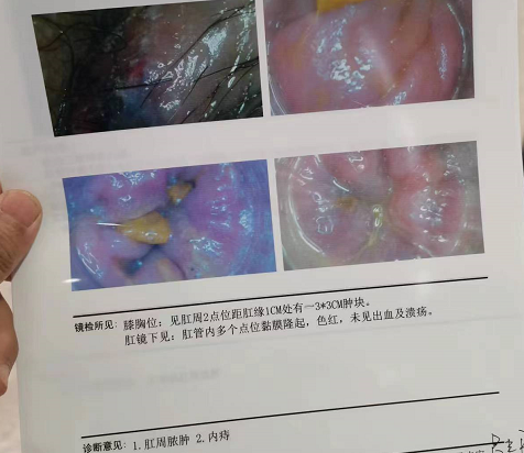 电子肛门镜确诊为肛周脓肿与内痔.png